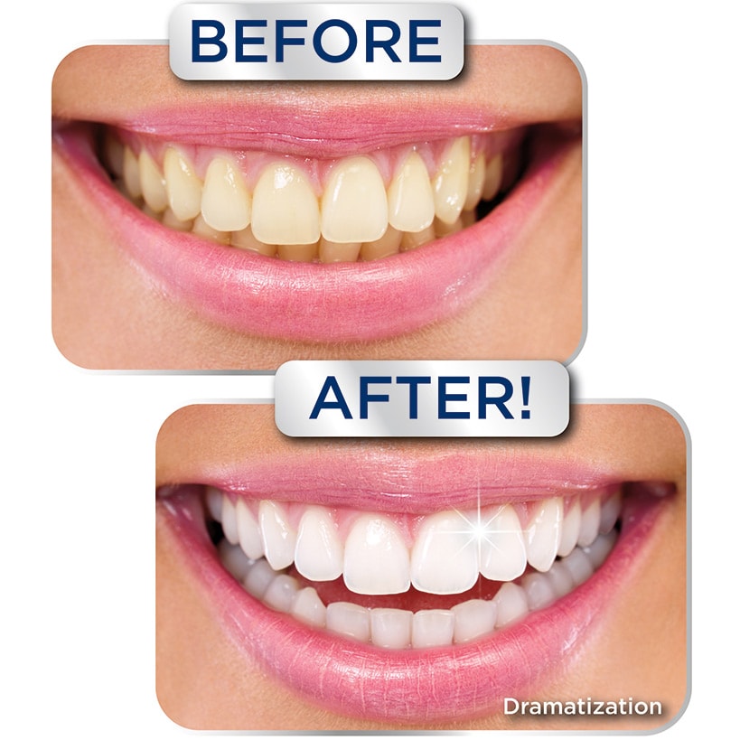 Miracle Smile® Teeth Whitening Gel - 2 Shades Whiter in 2 Minutes